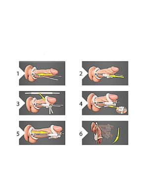Ekspander do penisa rozciągacz powiększanie penisa